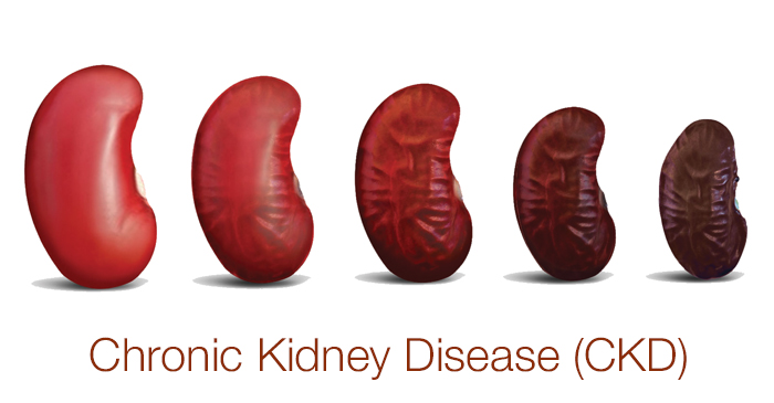 Chronic Kidney Disease CKD Prevalence Its Complications And 