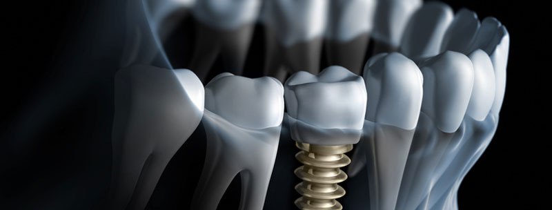 Dental implants adding value to people’s smile