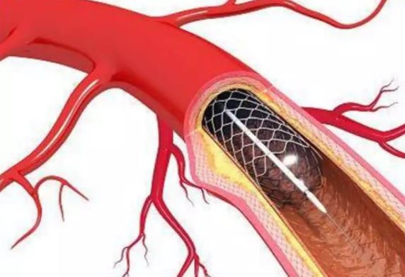 Cardiac stent price cap lowered further to Rs 28,000
