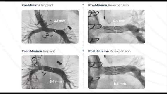 Renata Medical Receives FDA Approval For The Minima Growth Stent