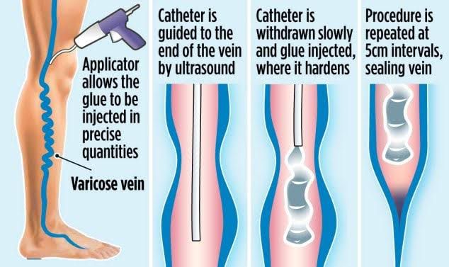 VenaSeal Glue Embolization: A Breakthrough in Varicose Vein Treatment