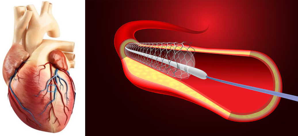 World Class ‘Made in India’ Coronary Stent faces ‘Blockage’ of Gangism in Europe