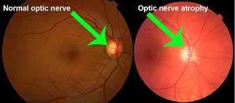 Diabetes Drug Linked To Increased Damage To The Optic Nerve