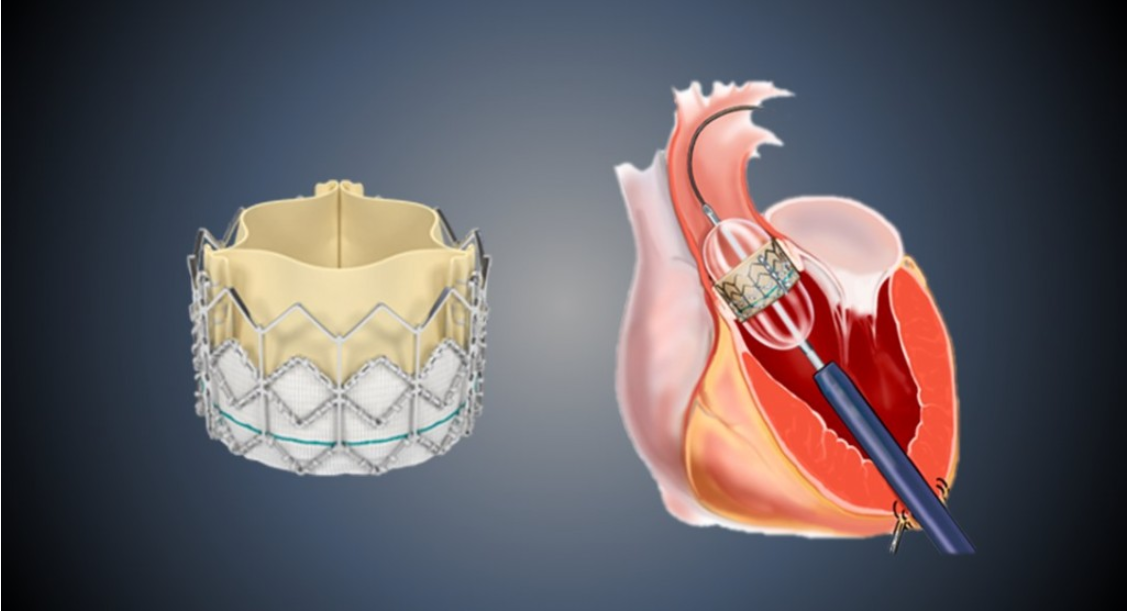 Zydus Medtech and Braile Biomedica of Brazil ink global licensing pact to commercialise TAVI technology