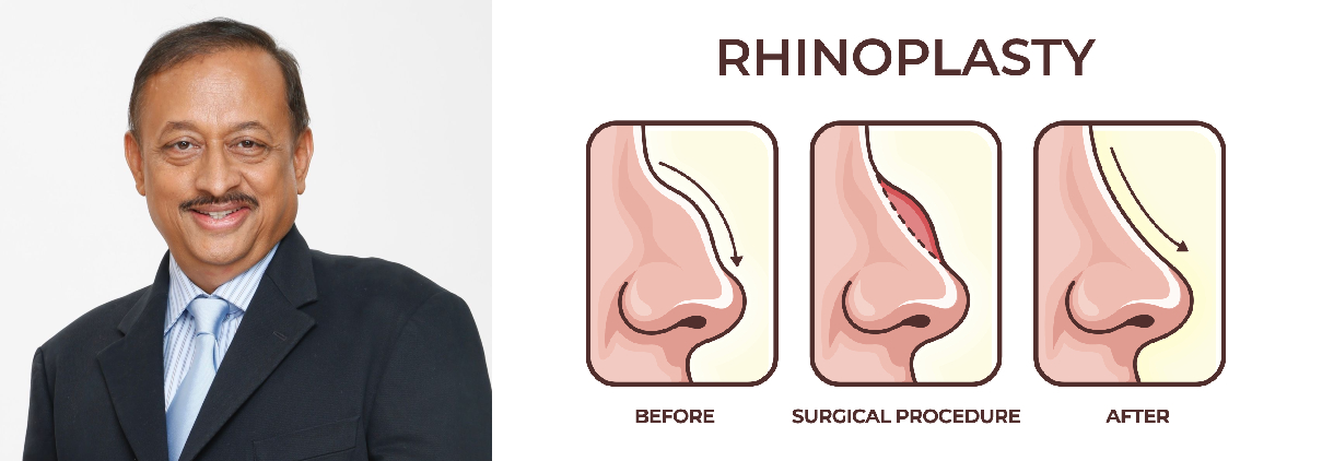 ‘Naak ka Sawal’ : Rhinoplasty is the Answer