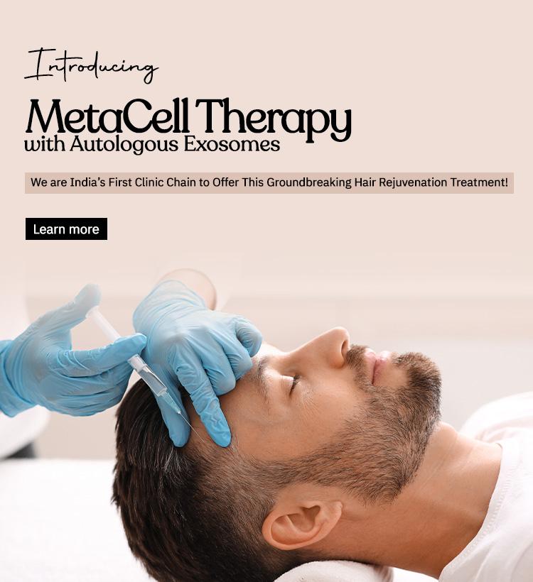 Hair Fall Nightmare Passé, here comes Non-Surgical Super Treatment