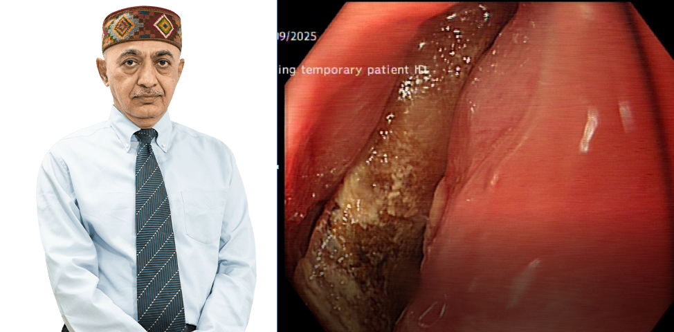 Laser rescued an Imperiled Food Pipe in Sir Ganga Ram Hospital