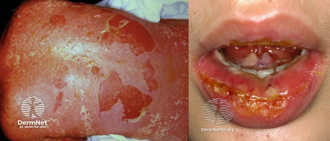 Popped the Pill, Paid the Price to Potentially Fatal Skin Syndrome