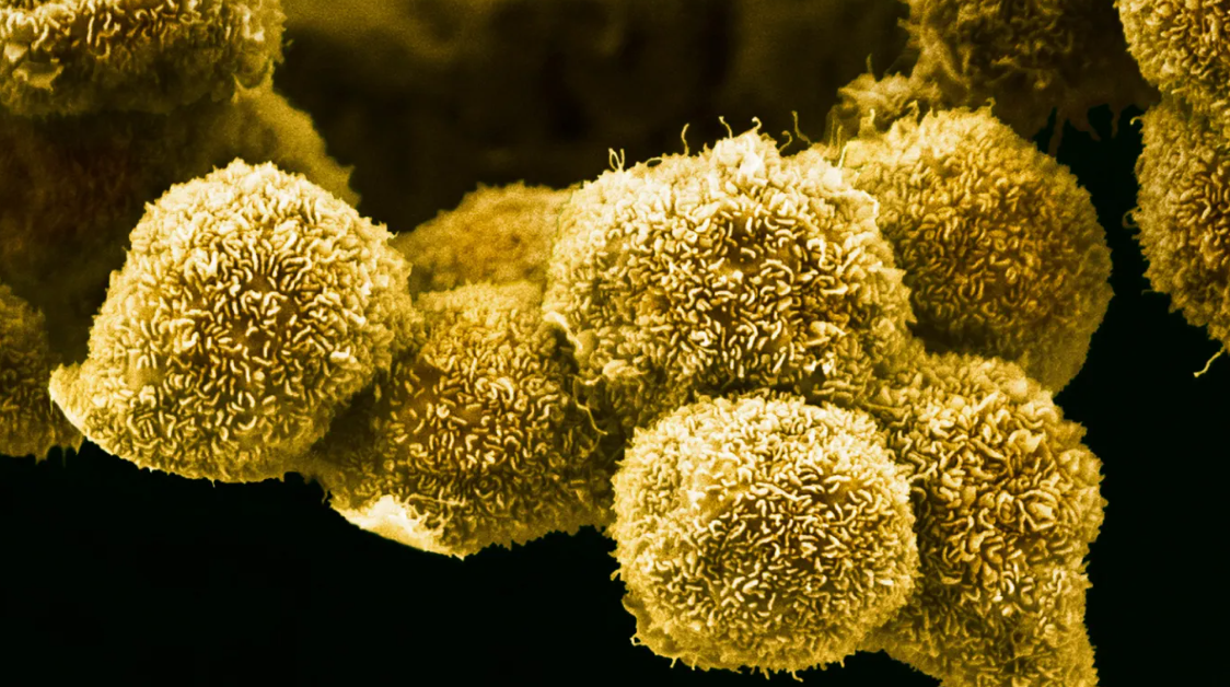 A new pancreatic cancer pill may be a game changer for patients