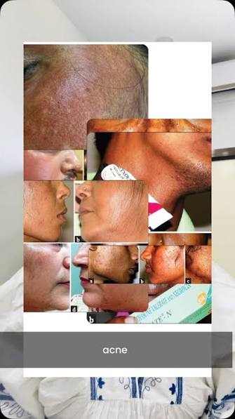 Steroid cream misuse fuels spurt in fungal infections