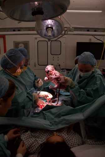 National Health Emergency: Telangana C-section Cluster Spark Critical Alarms as Substandard Drug Suspicions spread Nationwide